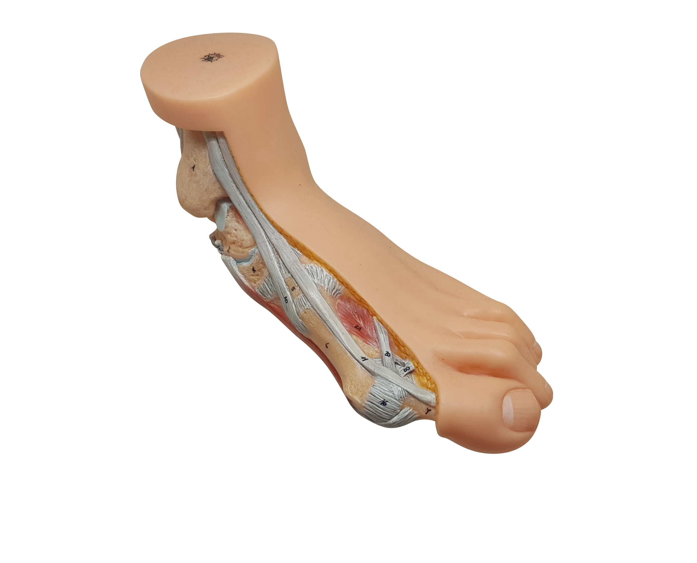 무지외반, Hallux_Valgus Foot